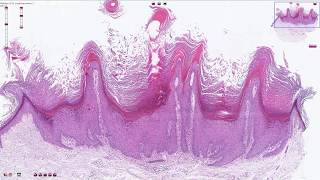 Verruca Vulgaris  Histopathology [upl. by Kathryn699]