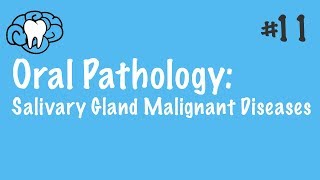 Warthin Tumor Salivay Gland Neoplasm  part 1 [upl. by Suiramed]