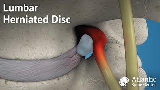 Lumbar Herniated Disc Overview [upl. by Ecirtemed]